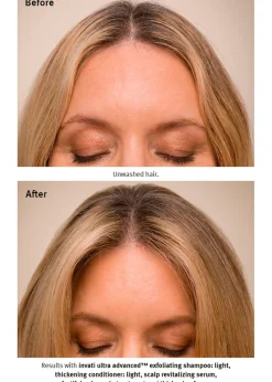 Invati Ultra Advanced™ System: Light