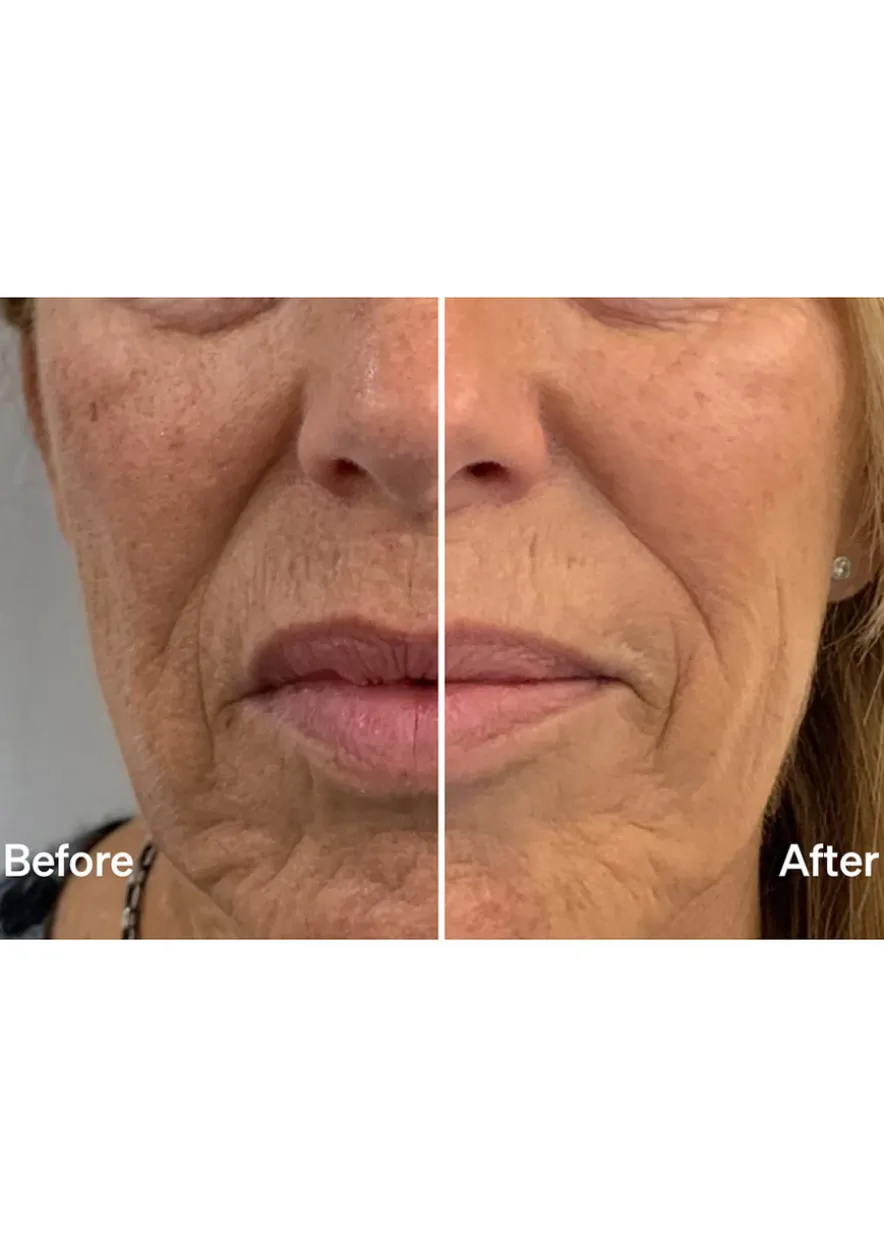 Laser Mist & Glide Refill 60 Days