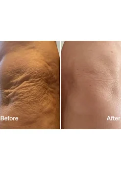 Laser Mist & Glide Refill 30 Days
